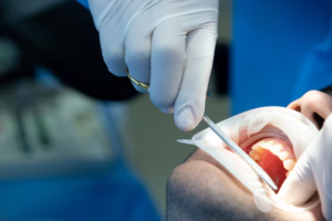 Can PRF Help Rebuild Bone Lost Around Damaged Teeth?